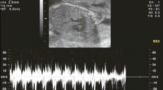 Ultrasound…it’s a boy!